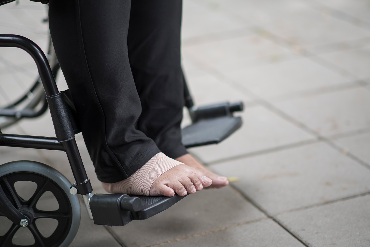 Artrite do Pé e Tornozelo